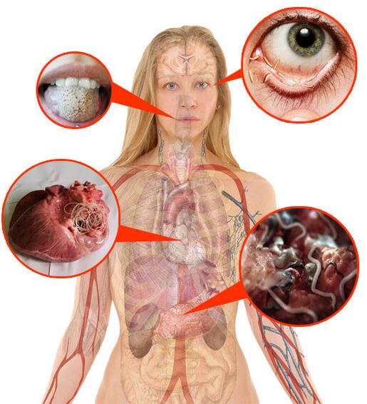 Parásitos e vermes no corpo humano