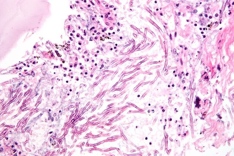 Os fungos perturban o sistema inmunitario e provocan a formación de micosis