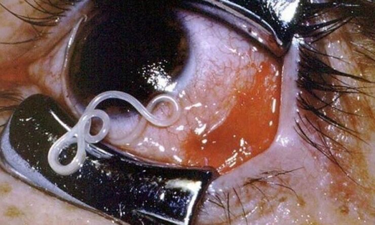 parasito nos ollos humanos